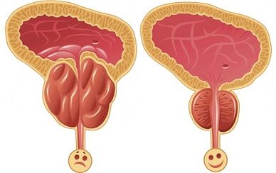 jak Prostalix působí na prostatitidu před a po léčbě