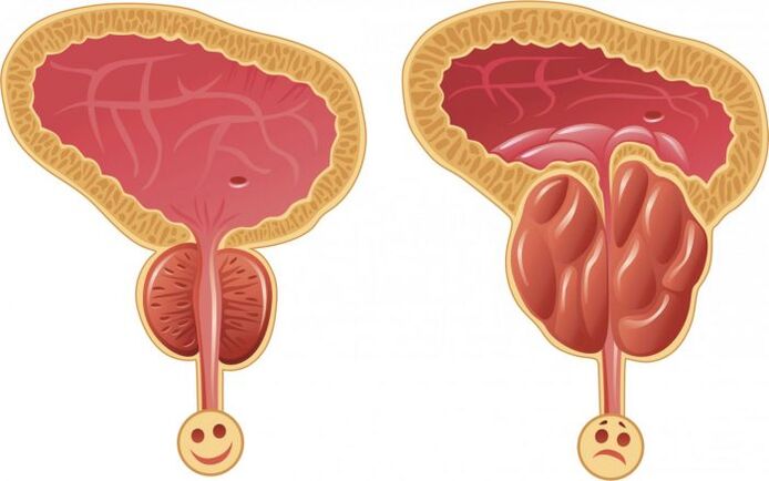 zdravá a zanícená prostata s prostatitidou