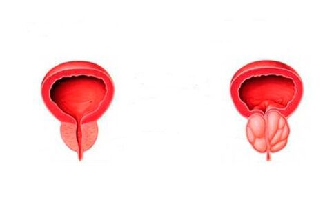 zdravá a zanícená prostata s prostatitidou