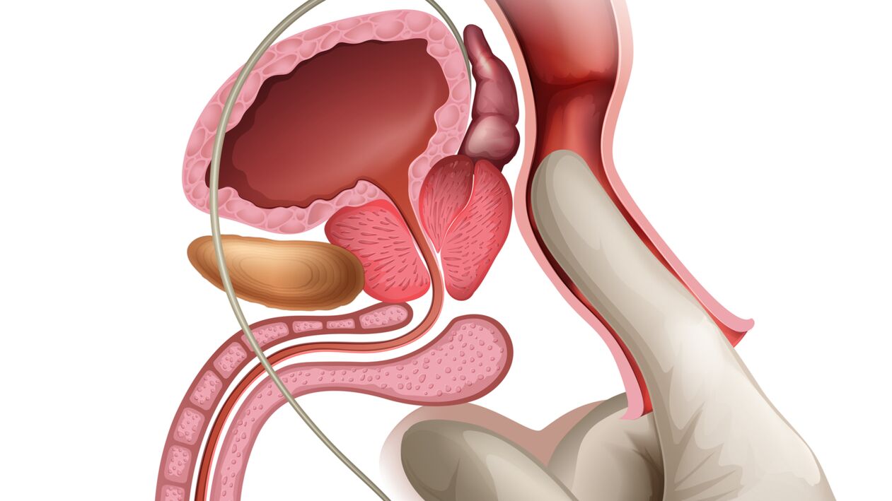 Masáž prostaty je účinný způsob léčby městnavé prostatitidy